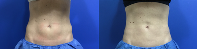 CoolSculpting before and after photo
