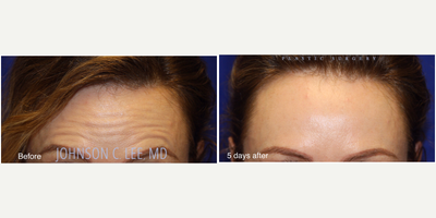 Dermal Fillers before and after photo