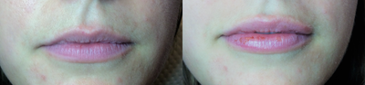 Dermal Fillers before and after photo