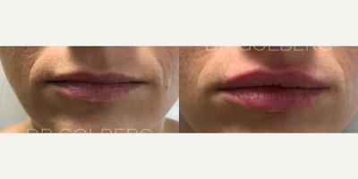 Lip Fillers before and after photo