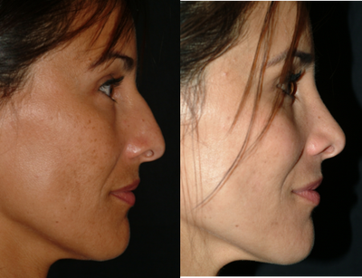 Rhinoplasty before and after photo
