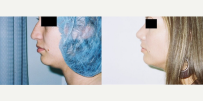 Rhinoplasty before and after photo