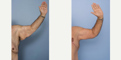Arm Lift before and after photo