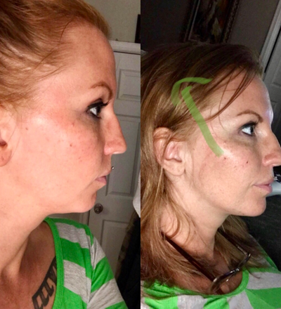 Dermal Fillers before and after photo