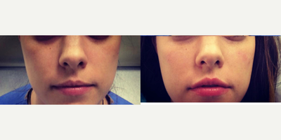 Restylane before and after photo