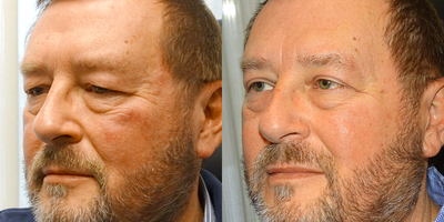 Ptosis Surgery before and after photo