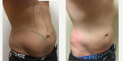 CoolSculpting before and after photo