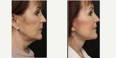 Facelift before and after photo
