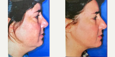 Liposuction before and after photo