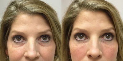 Restylane Refyne before and after photo