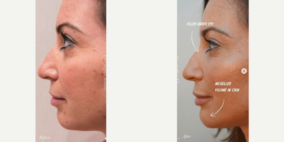 Dermal Fillers before and after photo