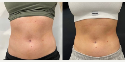 Evolve before and after photo