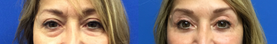 Eyelid Surgery before and after photo