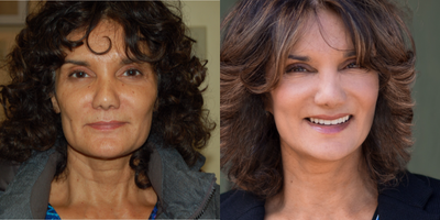 Facelift before and after photo