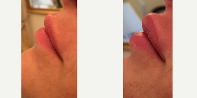 Lip Fillers before and after photo
