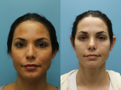 Revision Rhinoplasty before and after photo