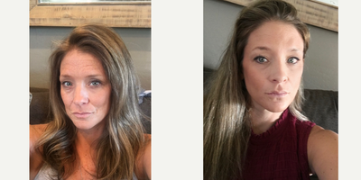 Fraxel Laser before and after photo