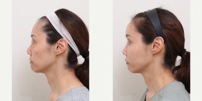 before and after image
