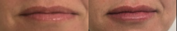 Restylane before and after photo