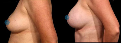 Breast Implant Revision before and after photo