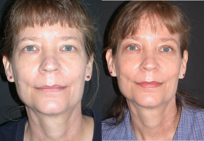 Brow Lift before and after photo