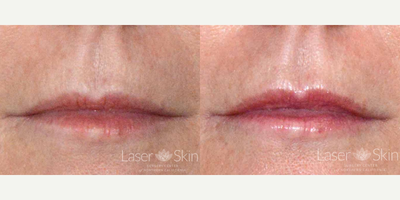 Juvederm before and after photo