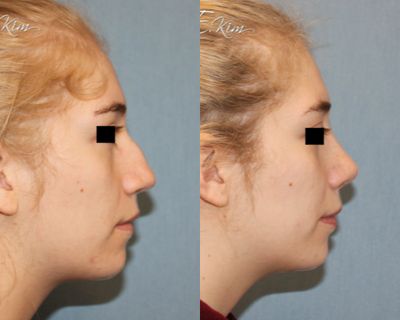 Rhinoplasty before and after photo