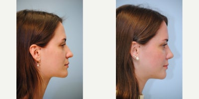 Rhinoplasty before and after photo