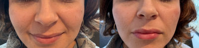 Voluma before and after photo