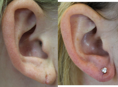 Earlobe Repair before and after photo