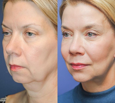 Eyelid Surgery before and after photo