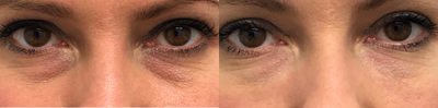 Restylane Refyne before and after photo