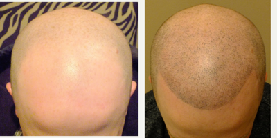 Scalp Micropigmentation before and after photo