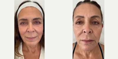 Botox before and after photo