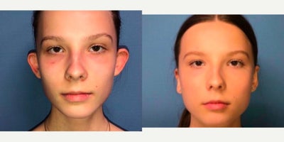 Ear Surgery before and after photo