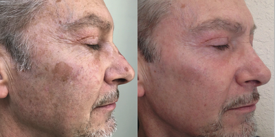 Halo Laser before and after photo