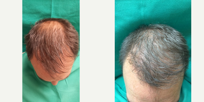 NeoGraft before and after photo