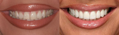 Porcelain Veneers before and after photo