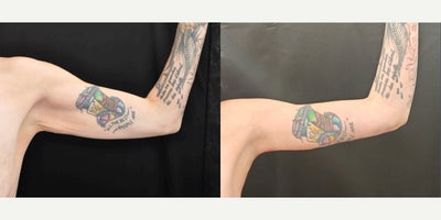 Arm Lift before and after photo