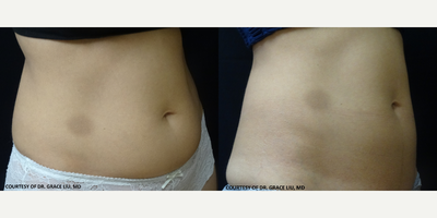 CoolSculpting before and after photo