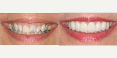 Dental Crown before and after photo