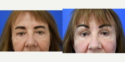 Brow Lift before and after photo