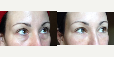Restylane Silk before and after photo