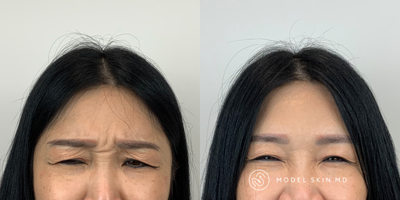 Botox before and after photo