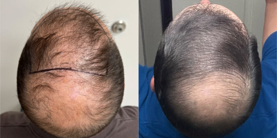 FUE Hair Transplant before and after photo