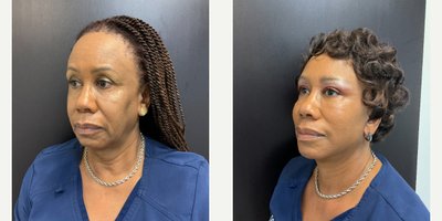 Mini Facelift before and after photo