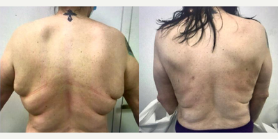 SlimLipo before and after photo