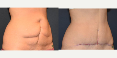 Tummy Tuck before and after photo