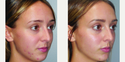 Chemical Peel before and after photo