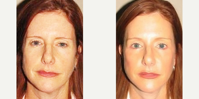 Facelift before and after photo